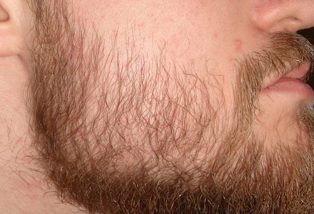 Пересадка волос