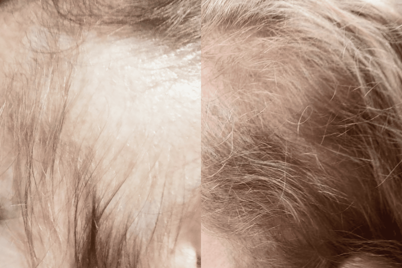 Результат пересадки волос