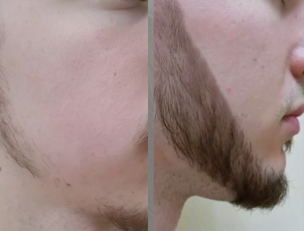 Результат пересадки волос