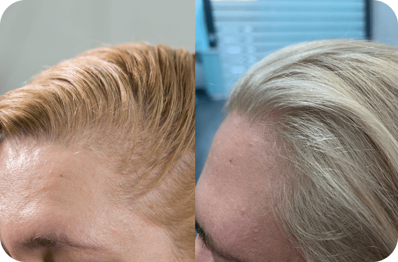 Результат пересадки волос