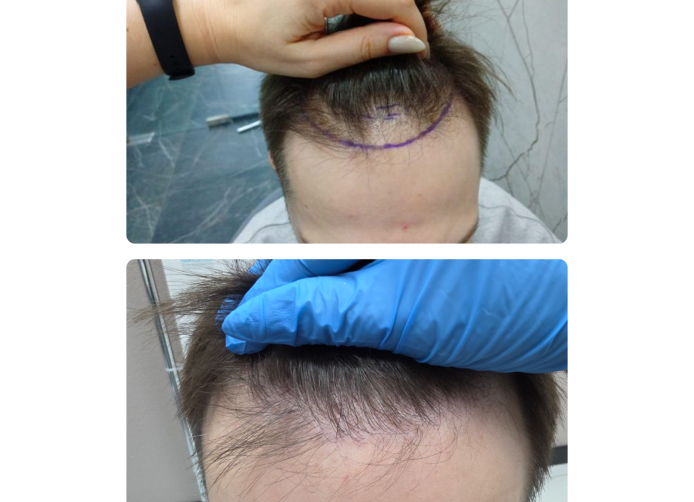 Результат пересадки волос