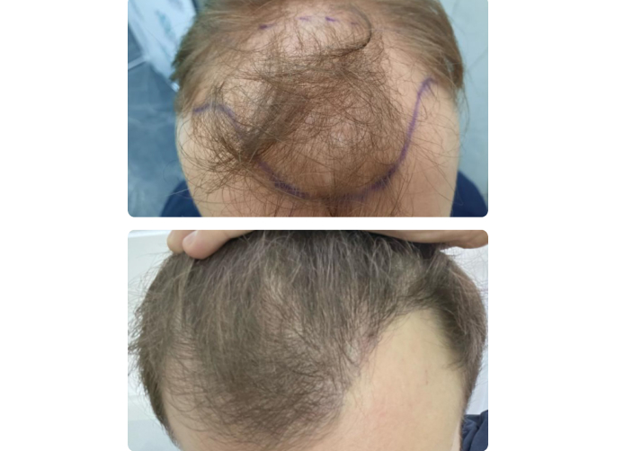 Результат пересадки волос