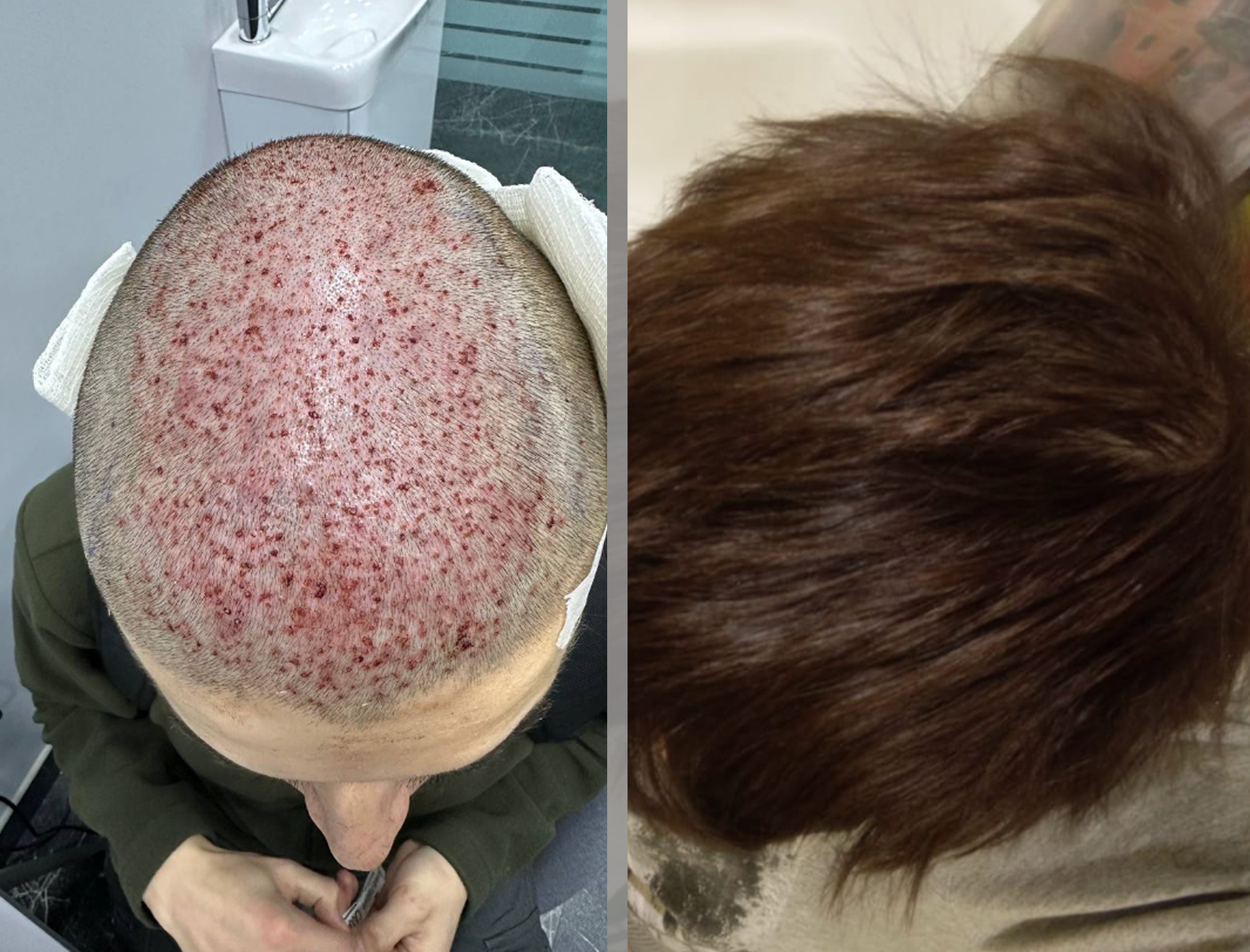 Результат пересадки волос