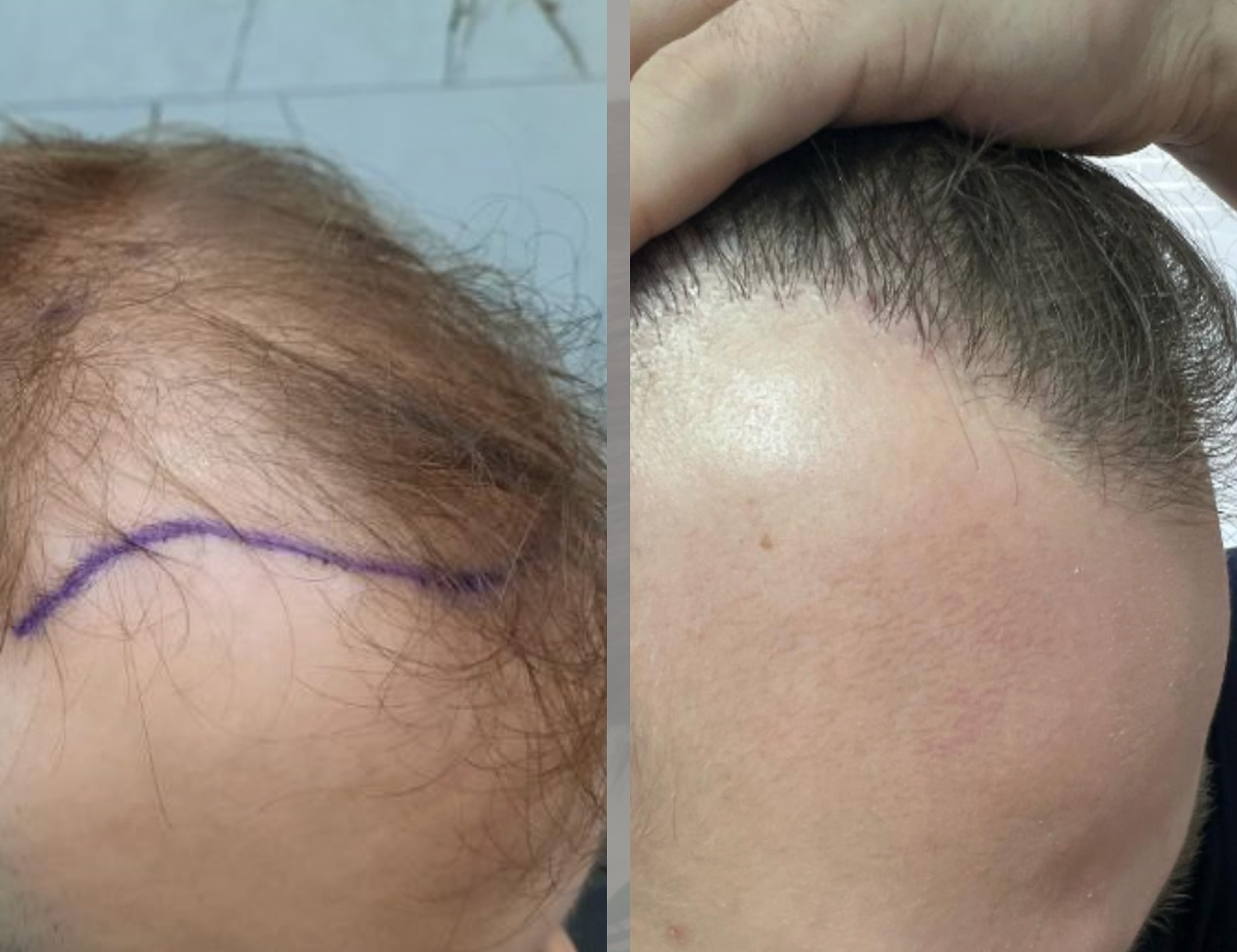 Результат пересадки волос