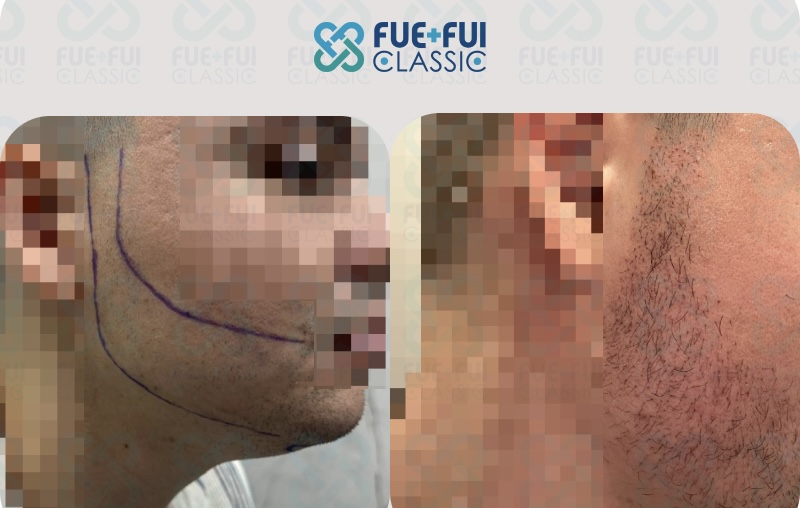 Результат пересадки волос