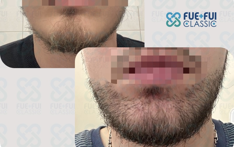 Результат пересадки волос