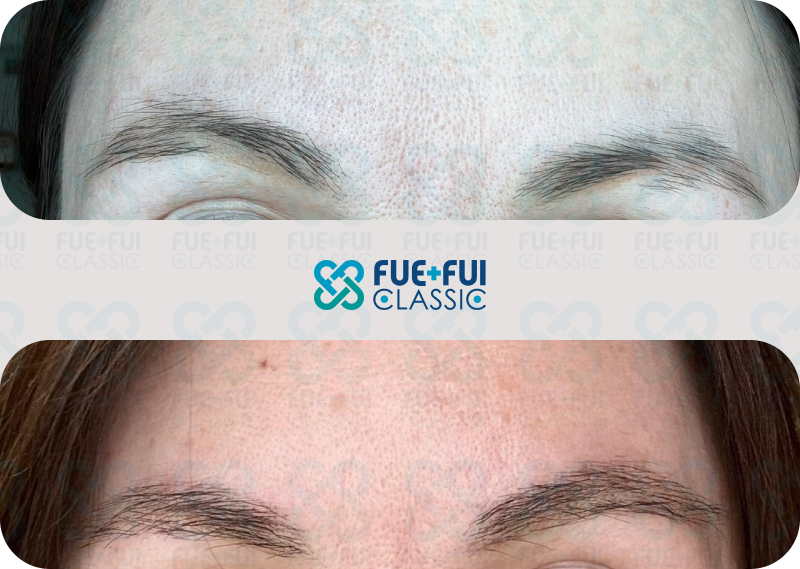 Результат пересадки волос