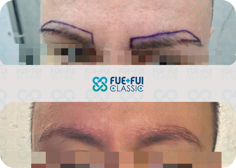 Результат пересадки волос