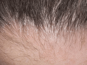 demodicosis of the scalp 1