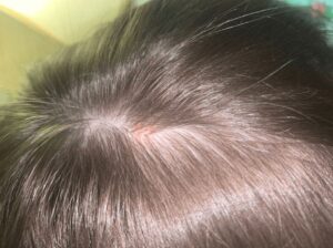treatment of allergic dermatitis of the scalp 2