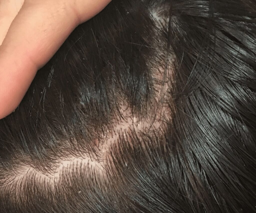 treatment of allergic dermatitis of the scalp 3