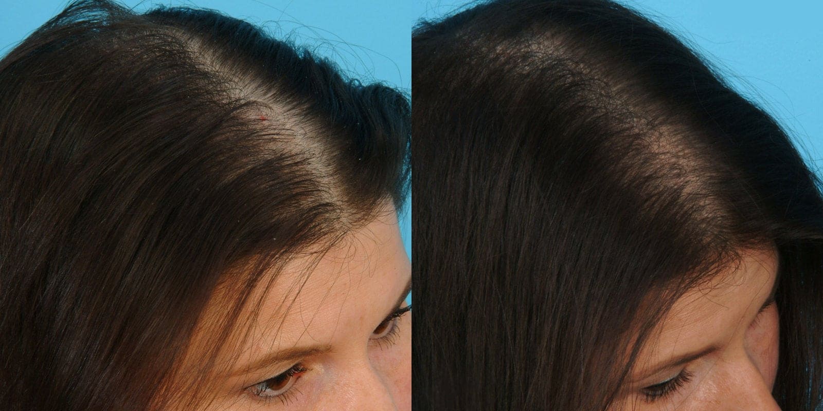 darsonval for hair with alopecia 4