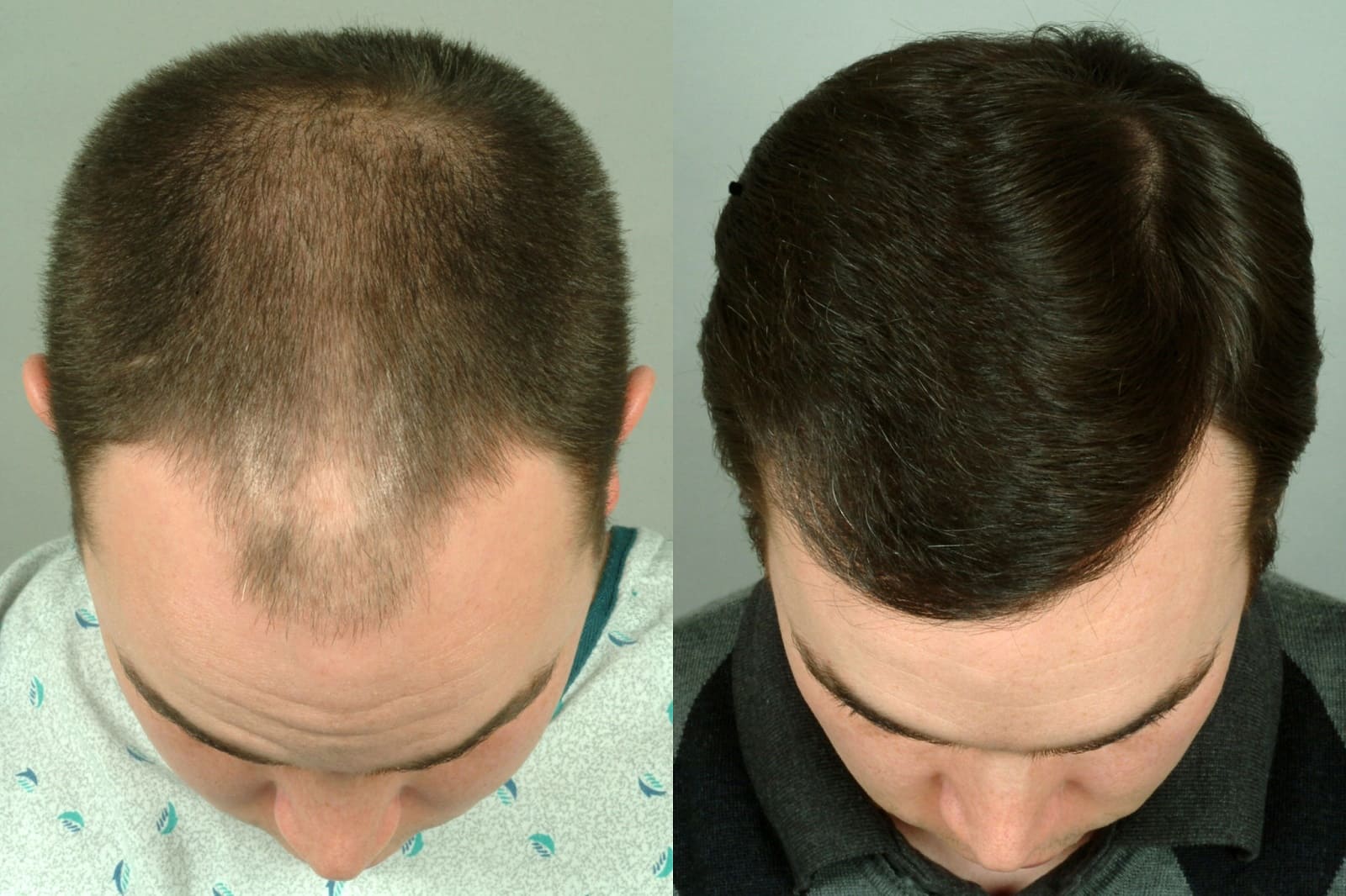 scalp reduction surgery for hair restoration 2