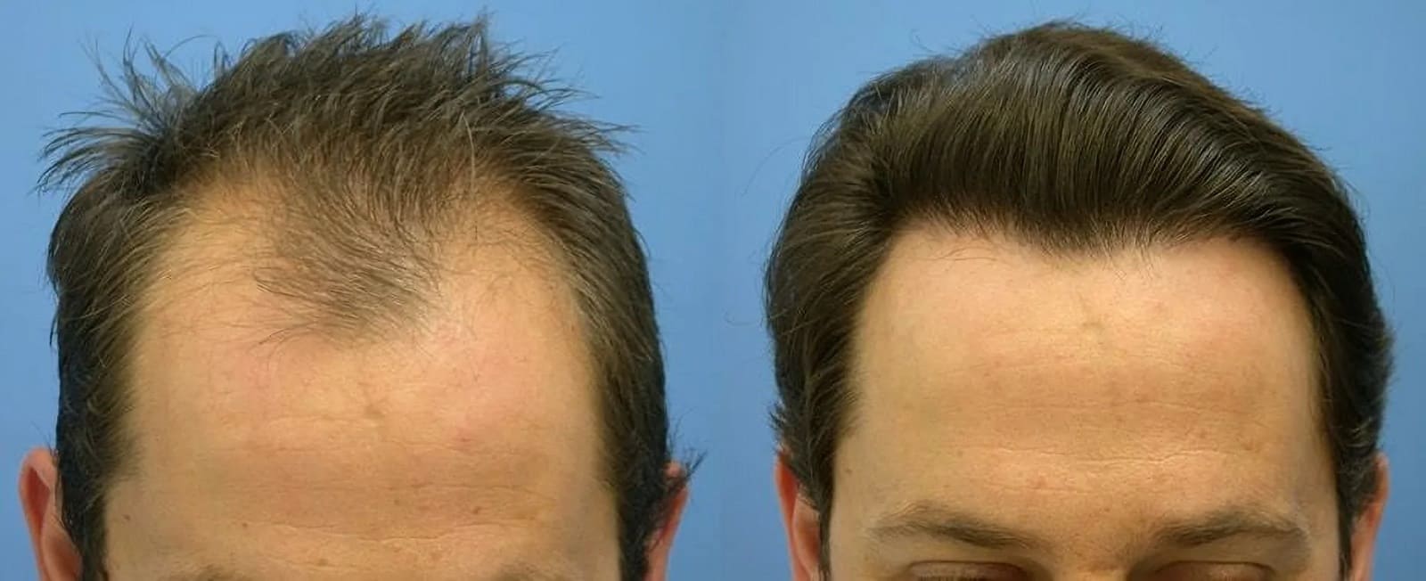 scalp reduction surgery for hair restoration 3