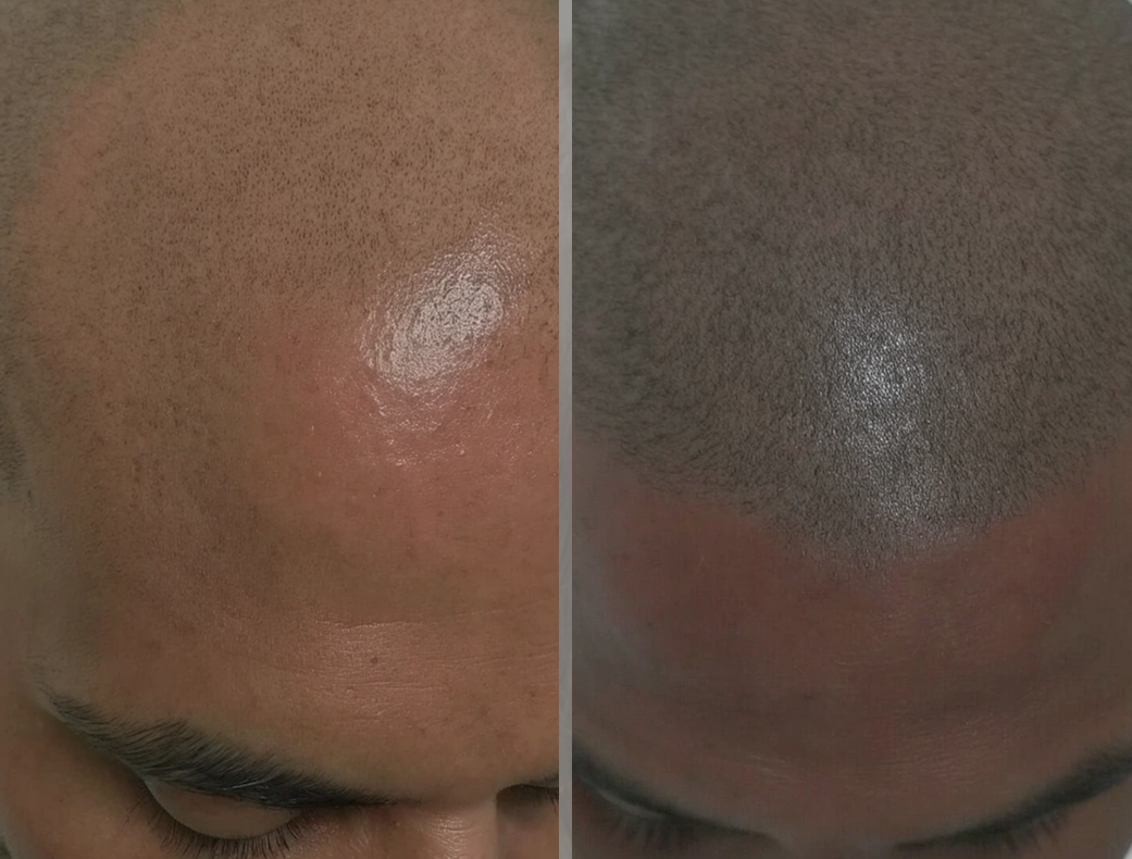 Результат пересадки волос