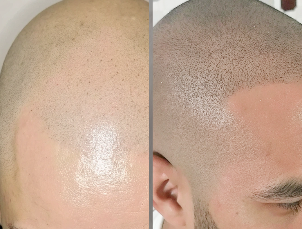 Результат пересадки волос