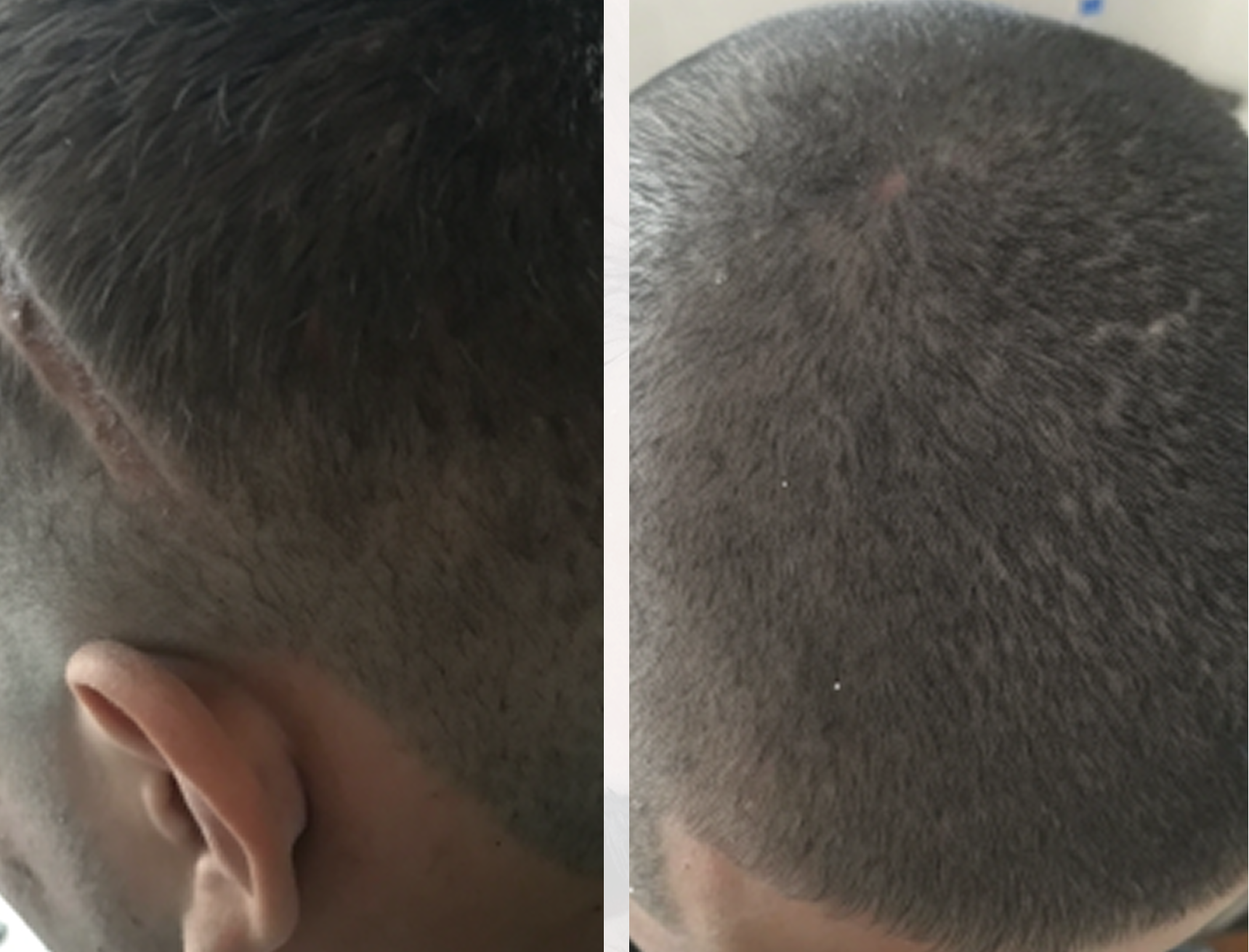 Результат пересадки волос