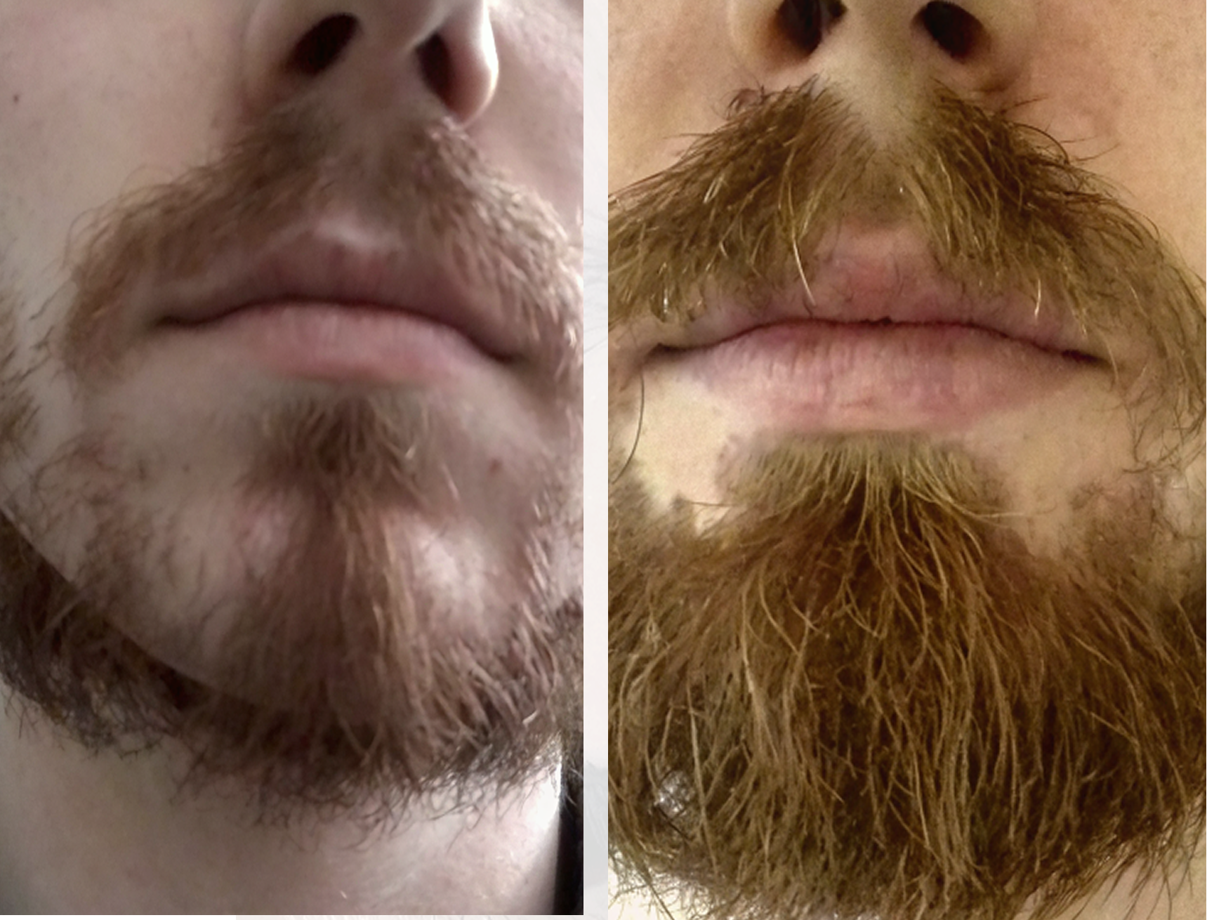 Результат пересадки волос