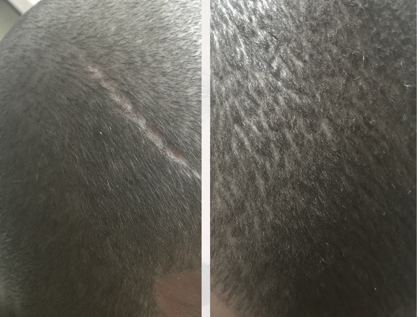 Результат пересадки волос