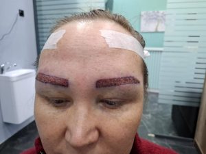 брови сразу после пересадки в фуе клиник
